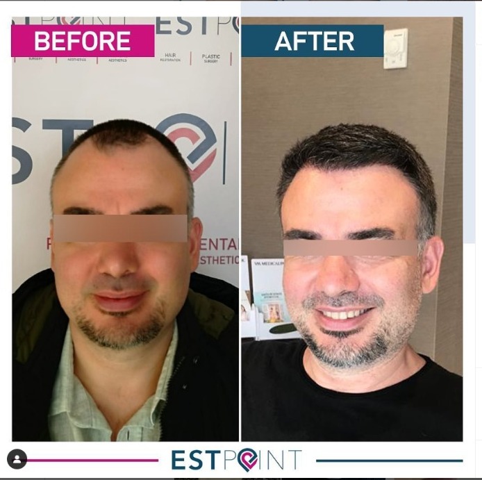 Saç Ekimi Öncesi Sonrası